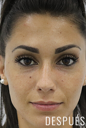 ojeras antes y despues (3)