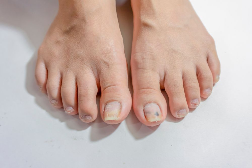 Qué son los hongos de los pies y cómo se pueden producir? - Foot and Body