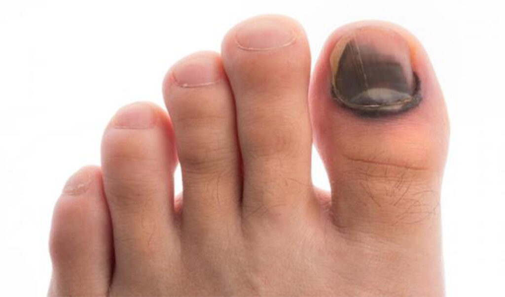Cuáles son las causas de los hongos en las uñas  Foot and Body