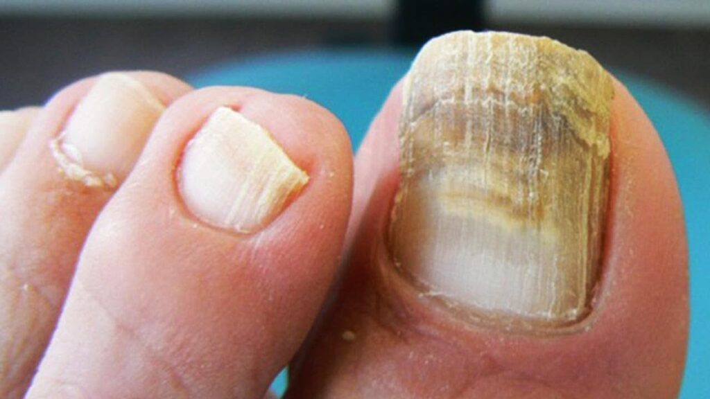 Cuáles son las causas de los hongos en las uñas? - Foot and Body