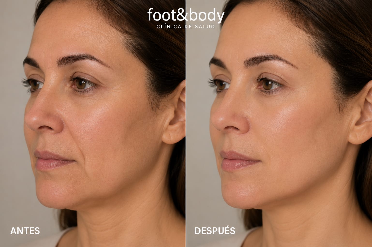 Antes y después Sculptra - Caso 2