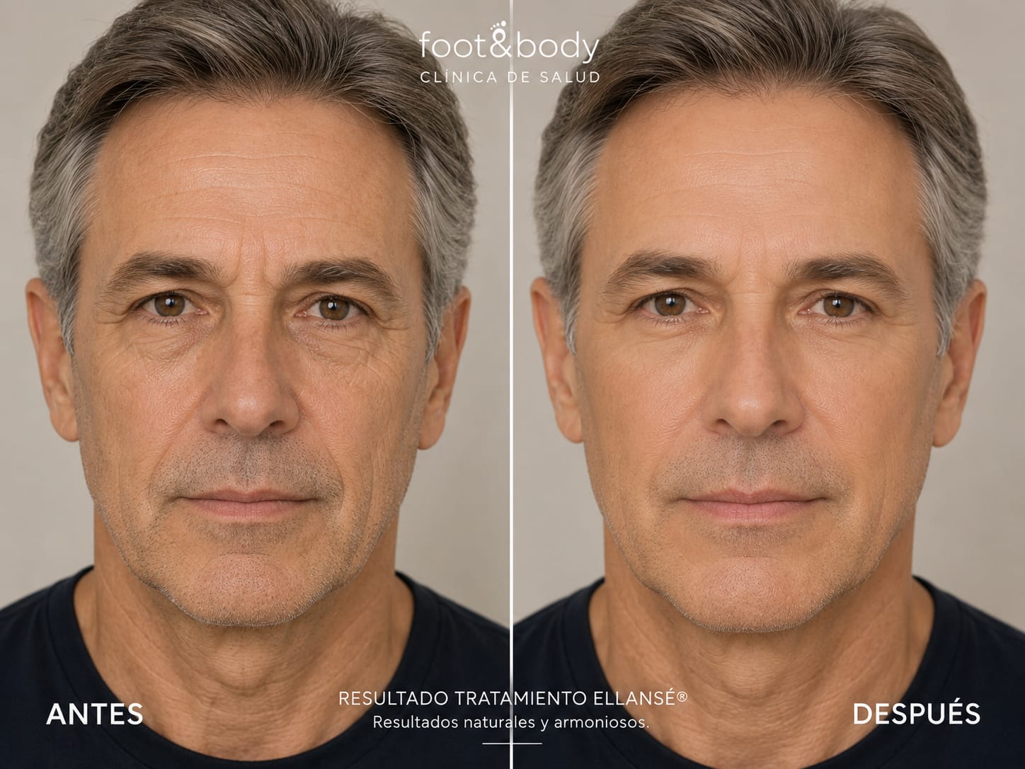 Antes y después Ellansé - Caso 1
