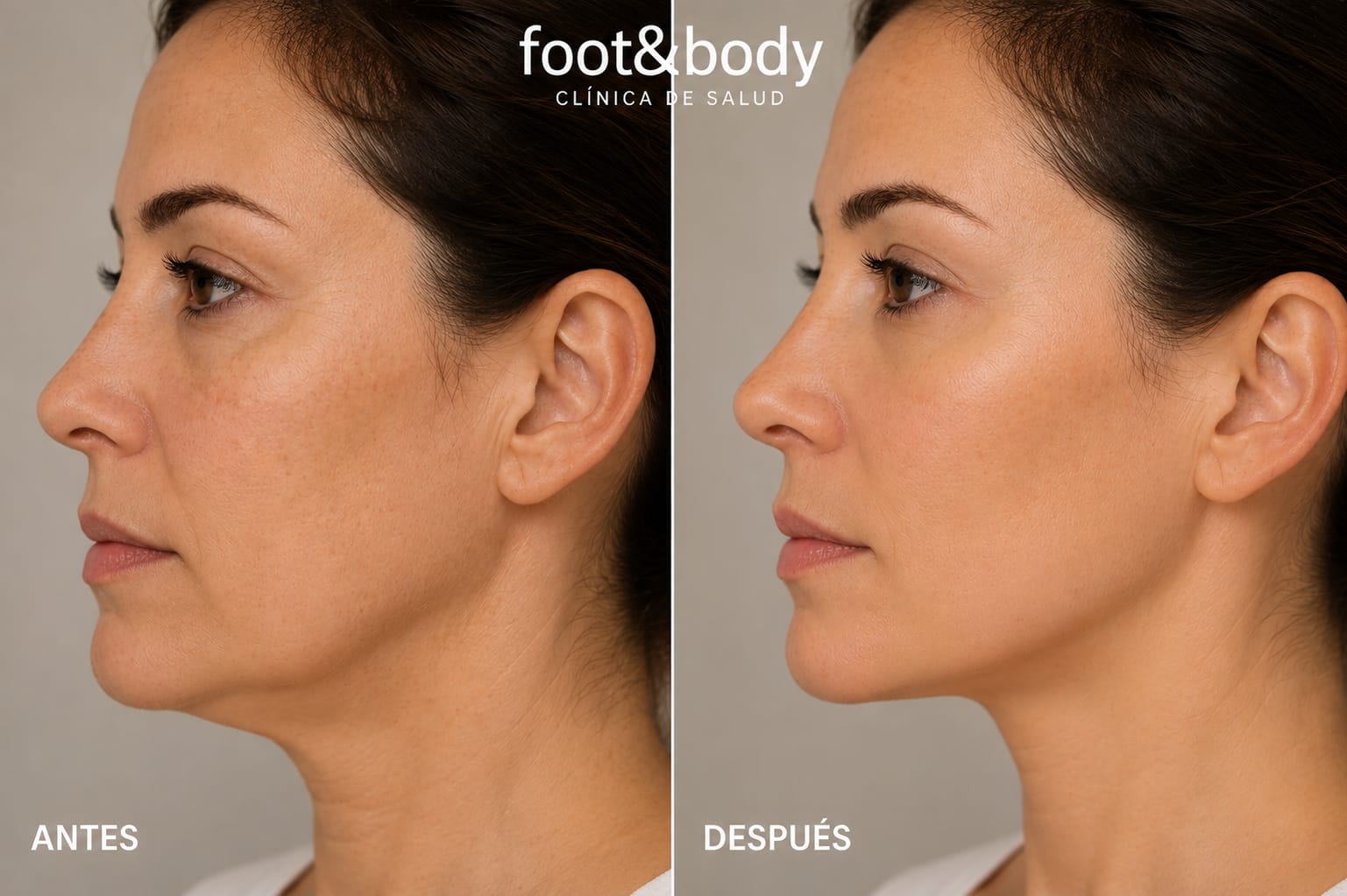 Antes y después Sculptra - Caso 1