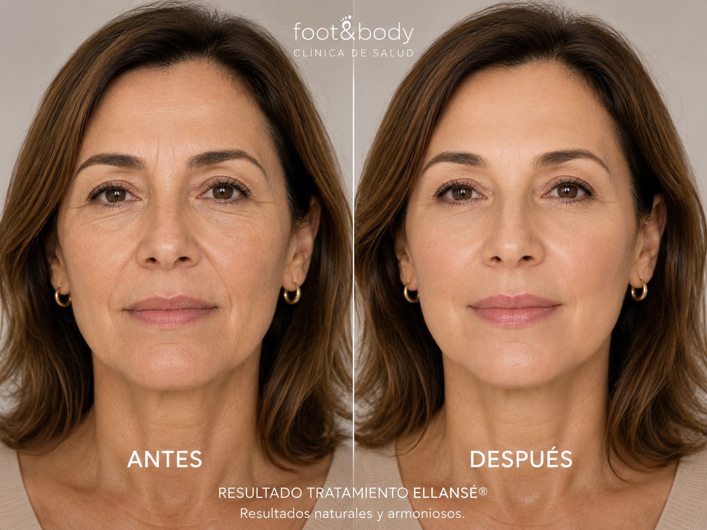 Antes y después Ellansé - Caso 3