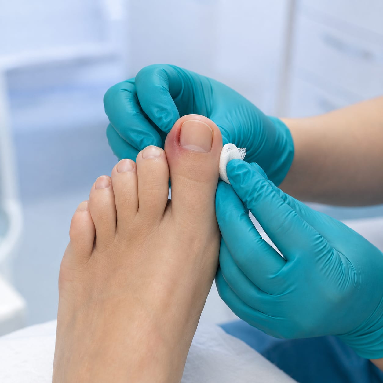 Uñas encarnadas