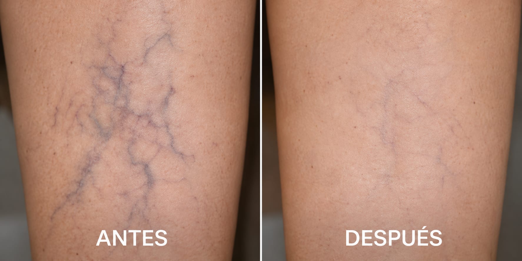 Antes y después del tratamiento de varices – Foot & Body Madrid