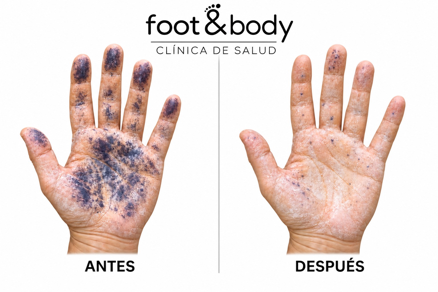 Palma de la mano. Test de Minor antes y después del tratamiento de hiperhidrosis en Foot & Body Madrid