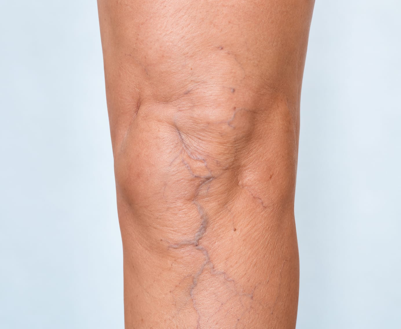 Varices superficiales