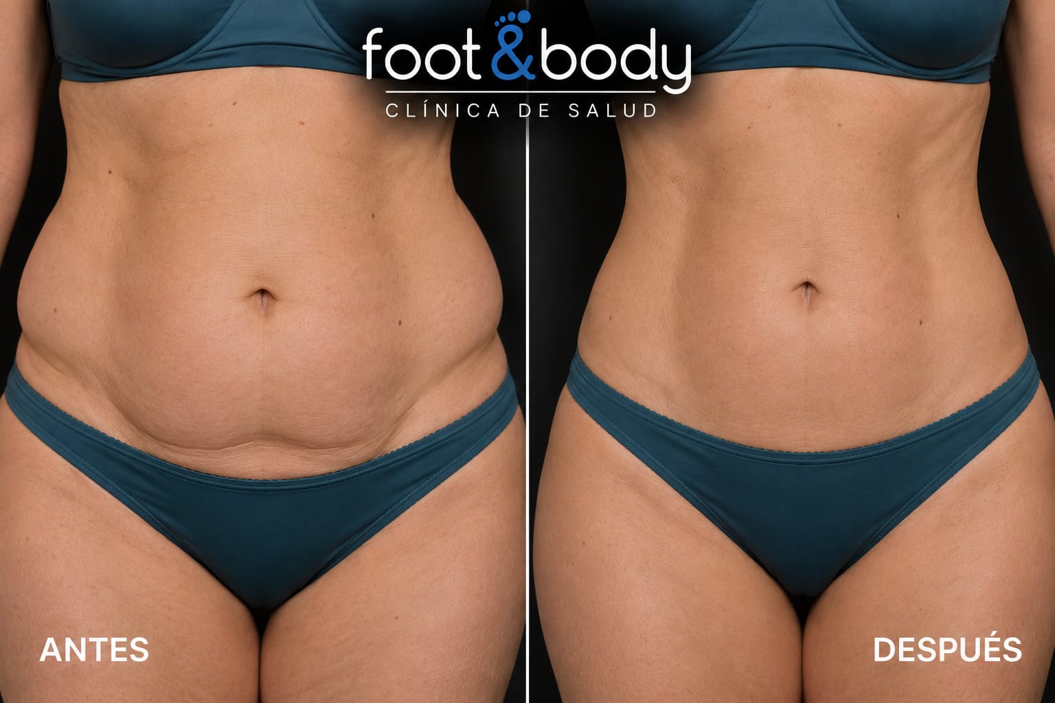 Antes y después tratamiento reductor corporal – Foot & Body Madrid