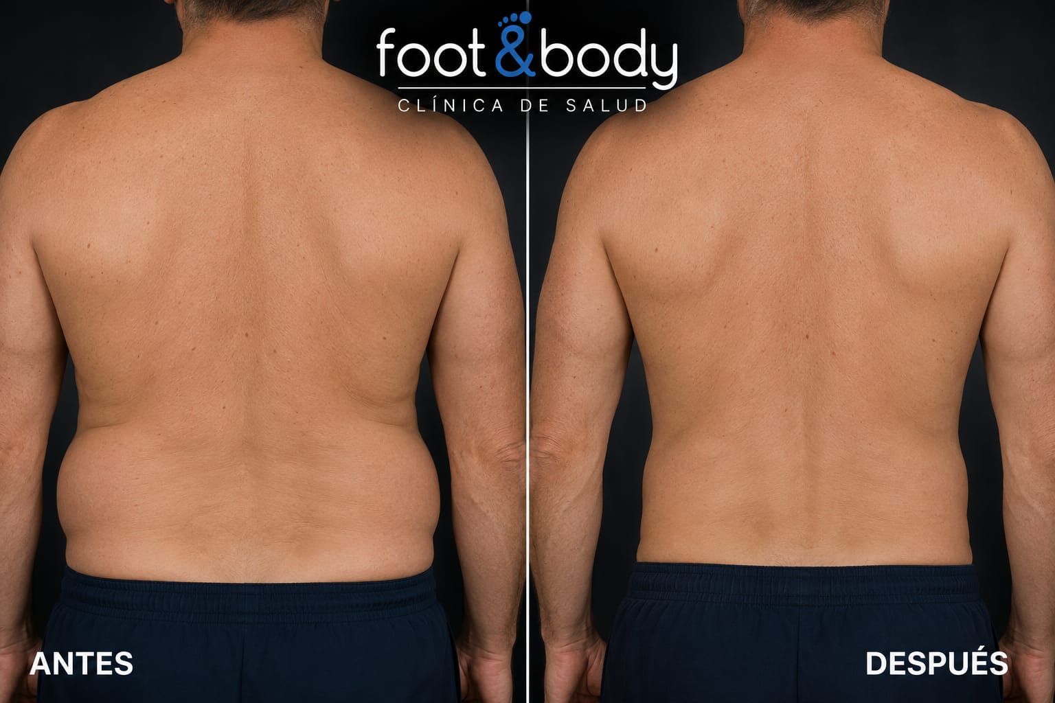 Antes y después tratamiento reductor corporal – Foot & Body Madrid