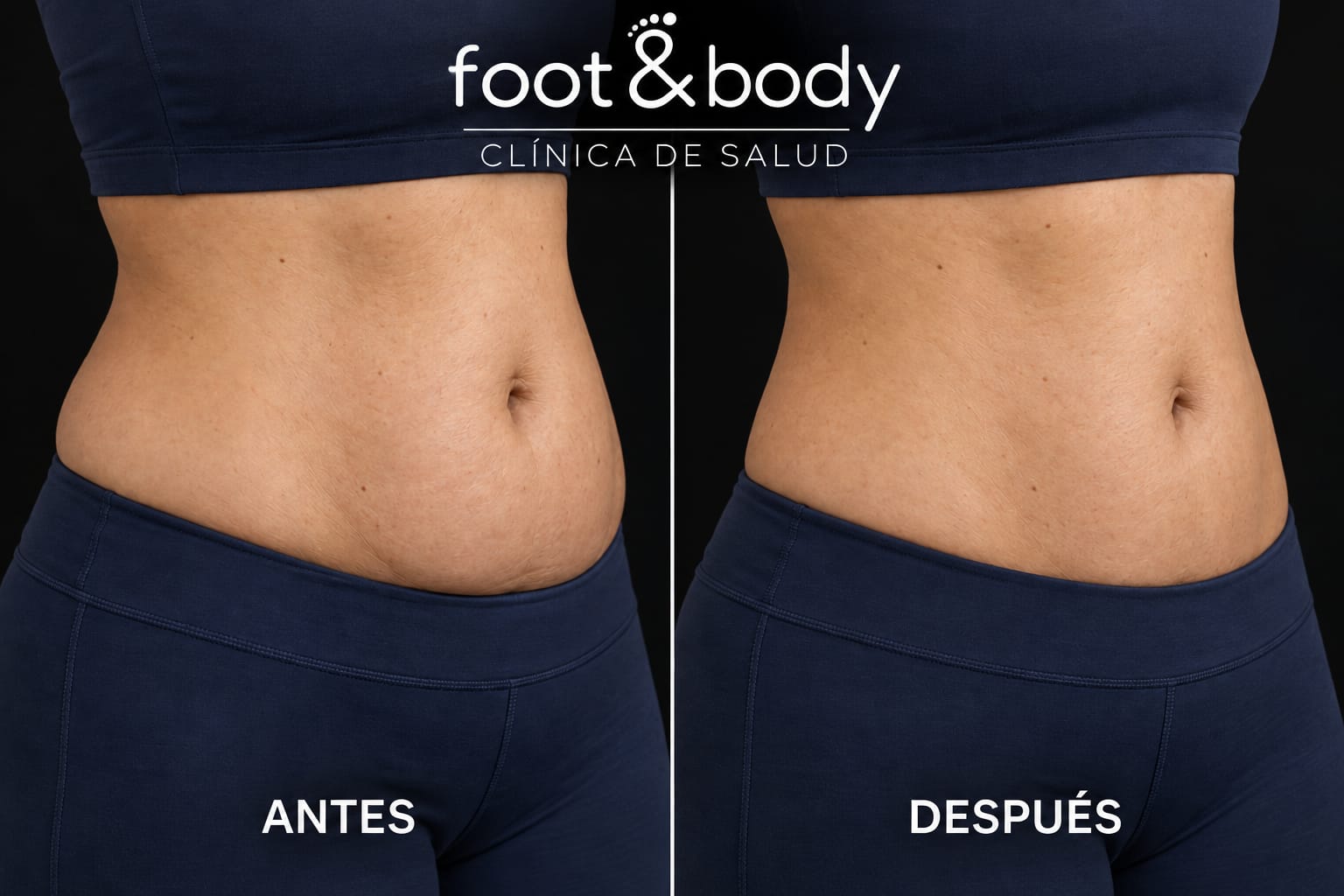 Antes del tratamiento de intralipoterapia
