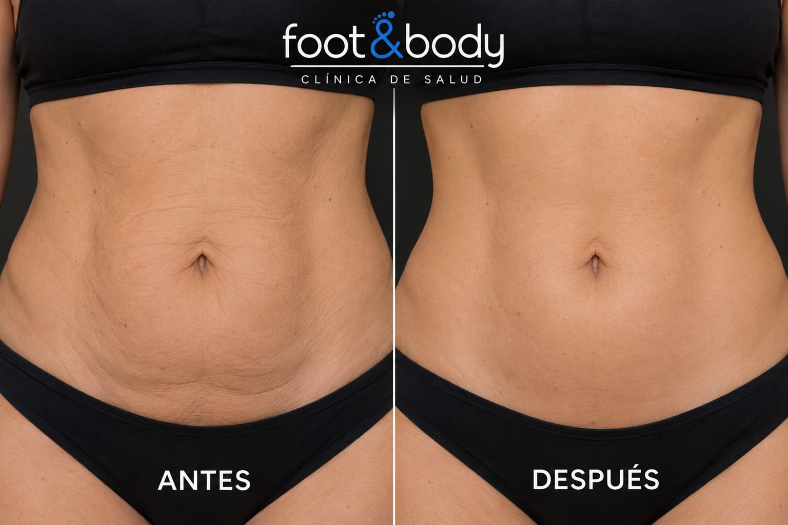 Abdomen antes y después