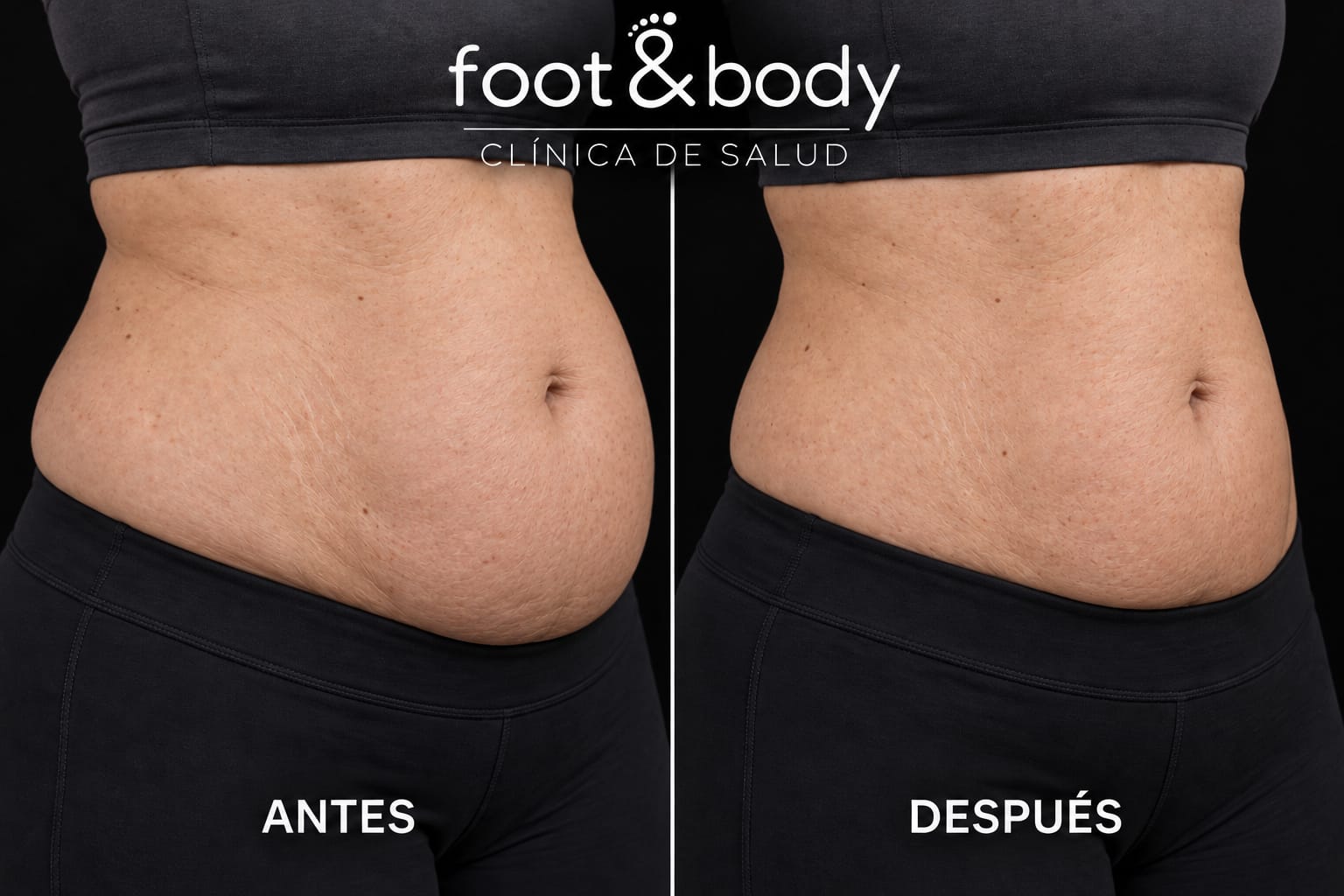 Después del tratamiento de intralipoterapia