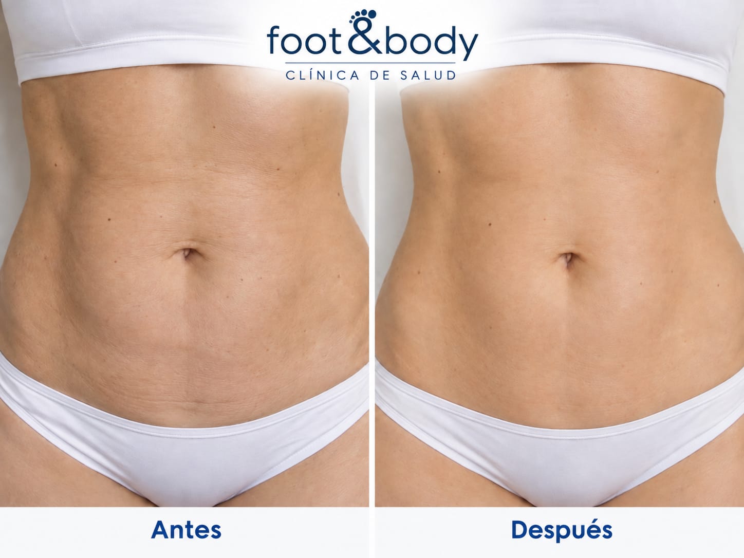 Después del tratamiento de mesoterapia
