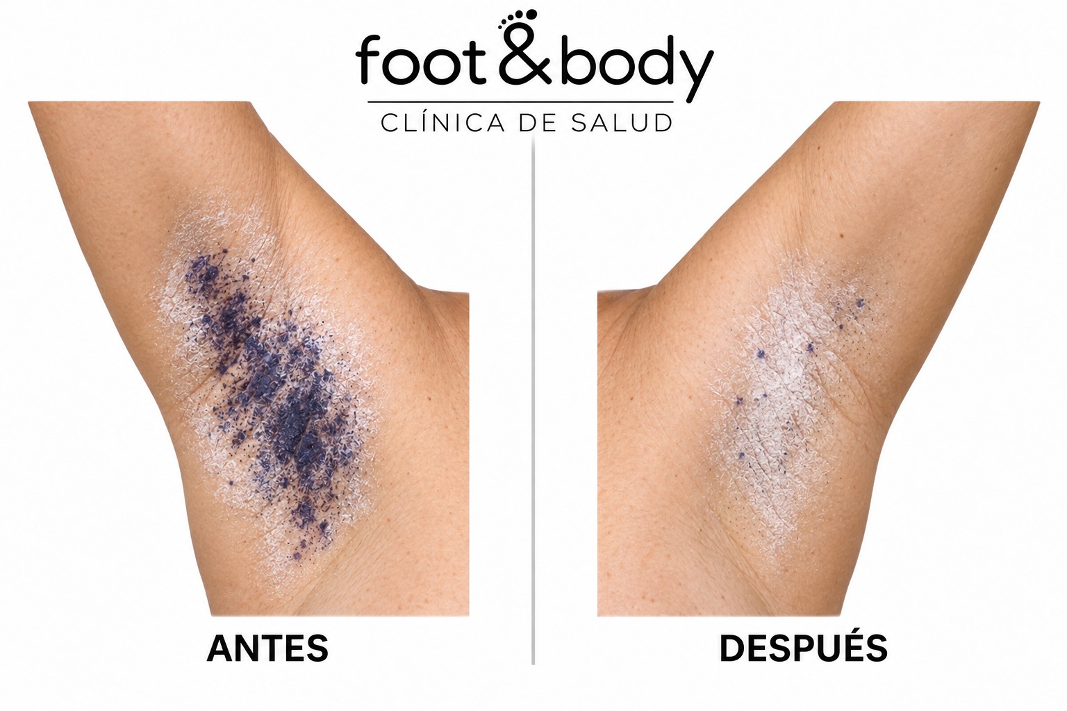 Axila. Test de Minor antes y después del tratamiento de hiperhidrosis en Foot & Body Madrid