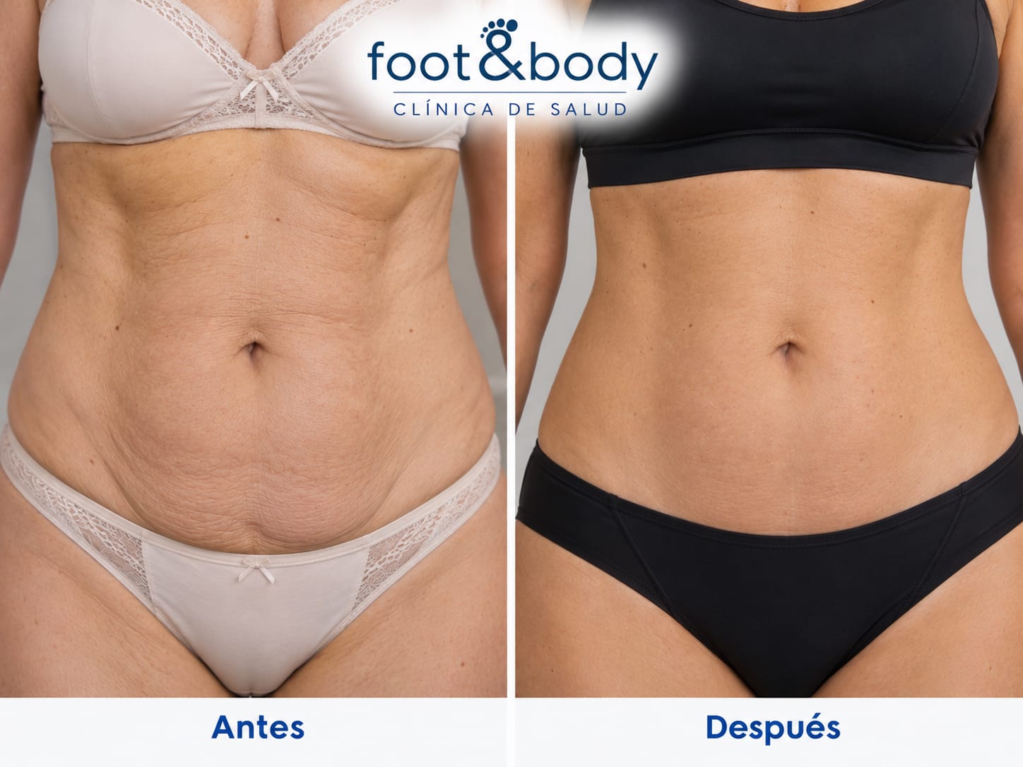 Antes del tratamiento de mesoterapia