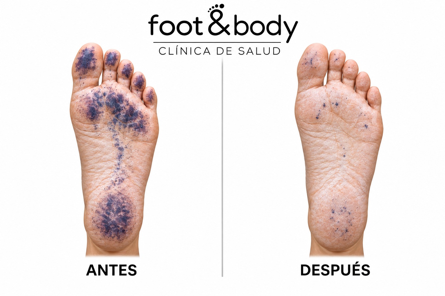 Planta del pie. Test de Minor antes y después del tratamiento de hiperhidrosis en Foot & Body Madrid